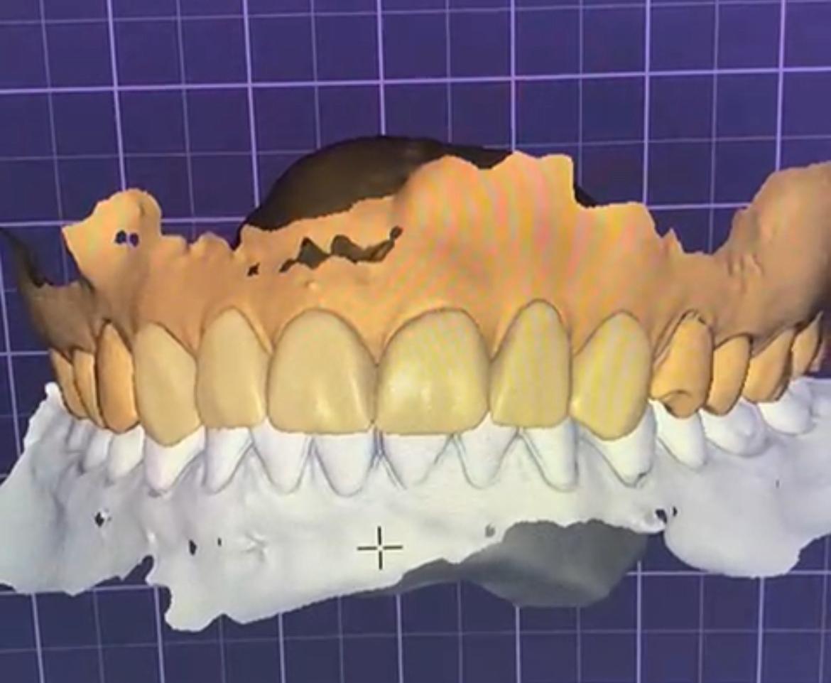 Dijital Gülüş Tasarımı Analizi