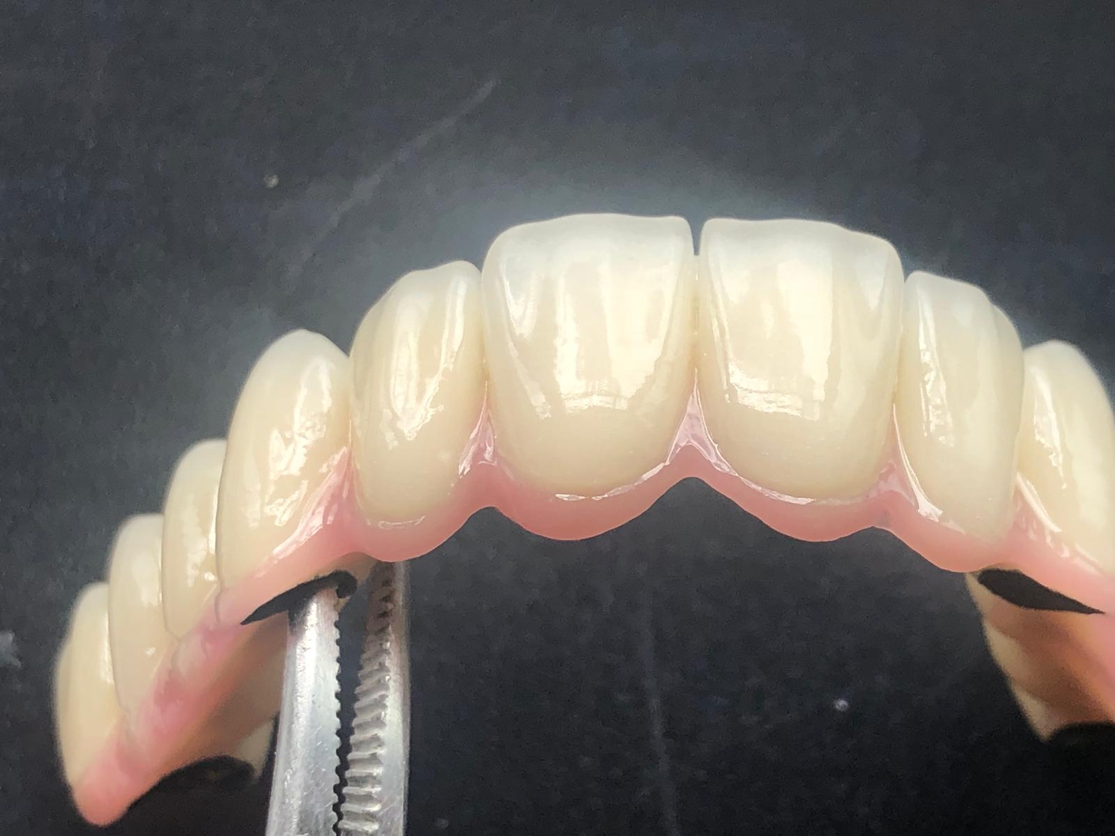 Metal Destekli Porselen